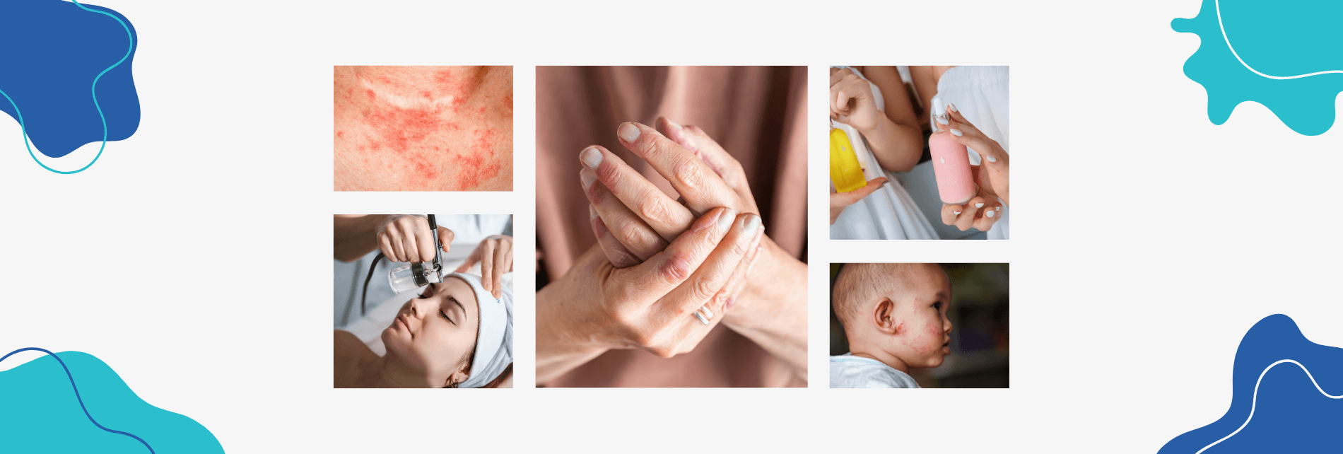 eczema