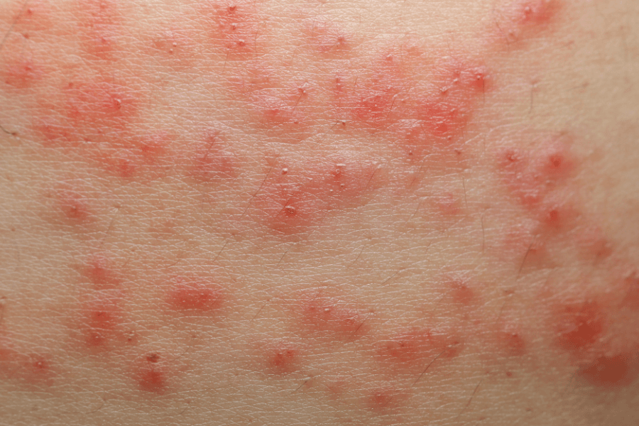 eczema