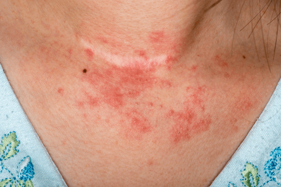 eczema