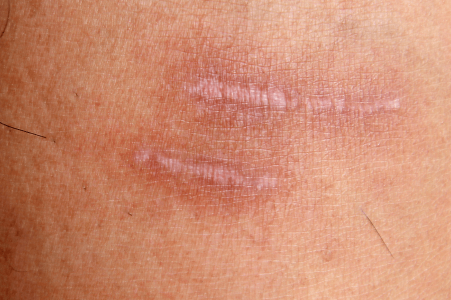 Scar Treatment