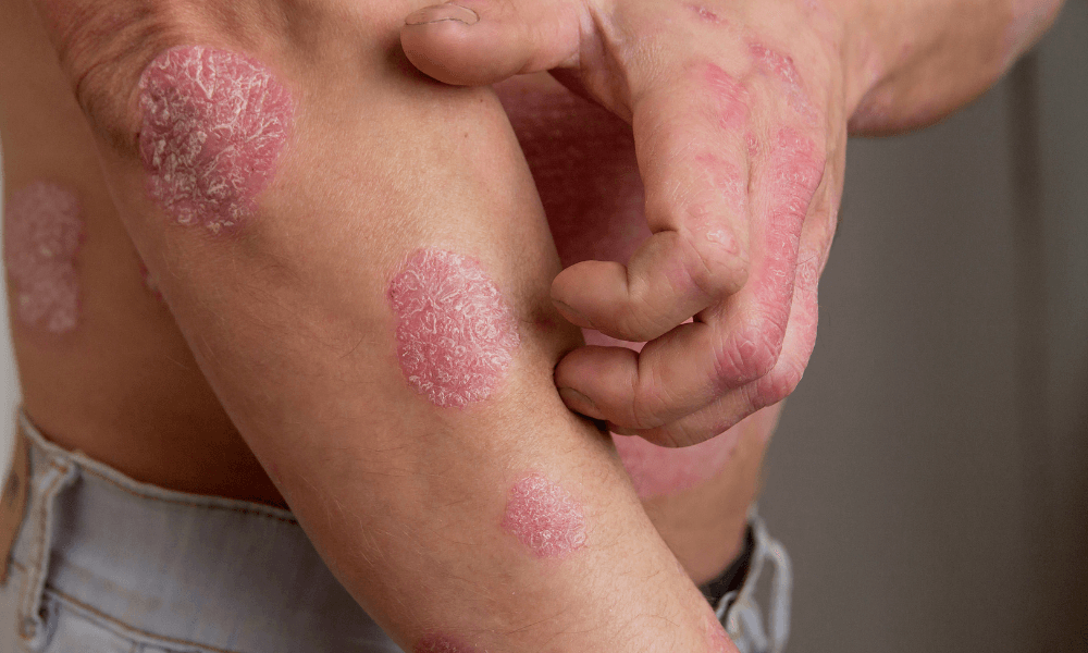 Psoriasis