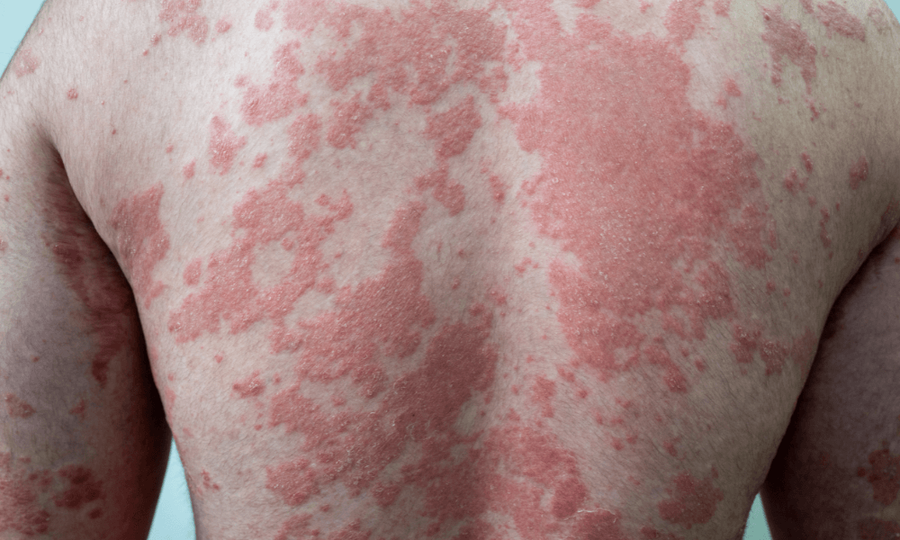 Psoriasis