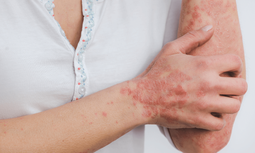 Psoriasis