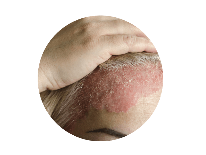 Psoriasis