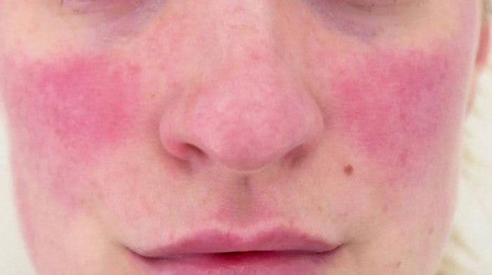 treatment of rosacea