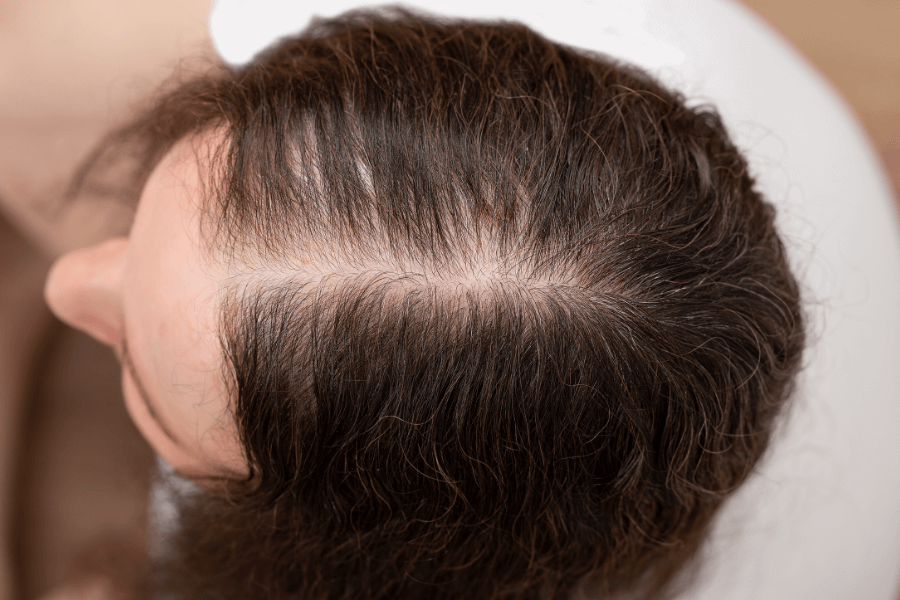 Hair Loss Treatment