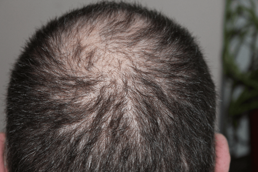 Hair Loss Treatment