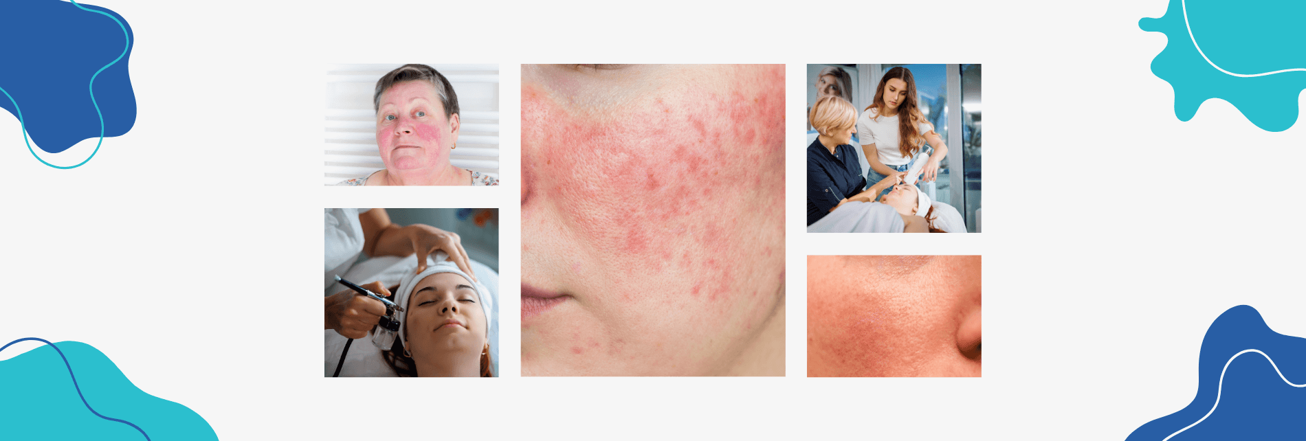 treatment of rosacea