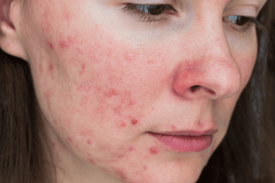 treatment of rosacea