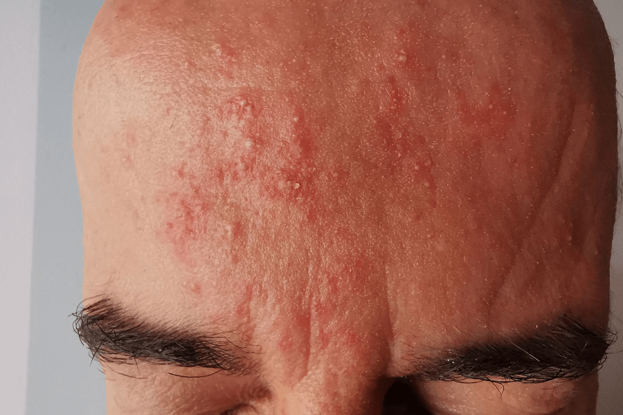 treatment of rosacea